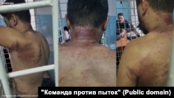 Телесные повреждения на теле Аскара. Фото: "Команда против пыток".