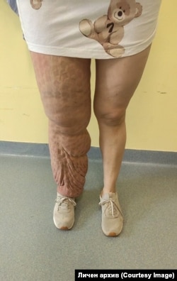Жена с лимфедем на долен крайник, пожелала да остане анонимна.