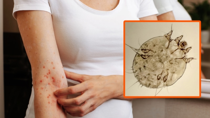 ღამის ქავილი და წითელი წერტილები - რა იწვევს მუნს და როგორ დაიცვა თავი