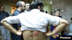 Armenia - An Armenian cameraman shows an injury sustained during the dispersal of an opposition rally in Yerevan's Sari Tagh neighborhood, 30Jul2016.