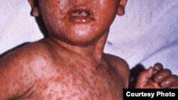 Pakistan -- Measles spread in Khost, 23Jan2012