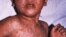 Pakistan -- Measles spread in Khost, 23Jan2012