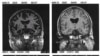 سمت چپ: مغز فرد دچار به آلزایمر، سمت راست: مغز فرد غیرمبتلا به آلزایمر