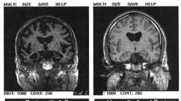 سمت چپ: مغز فرد دچار به آلزایمر، سمت راست: مغز فرد غیرمبتلا به آلزایمر