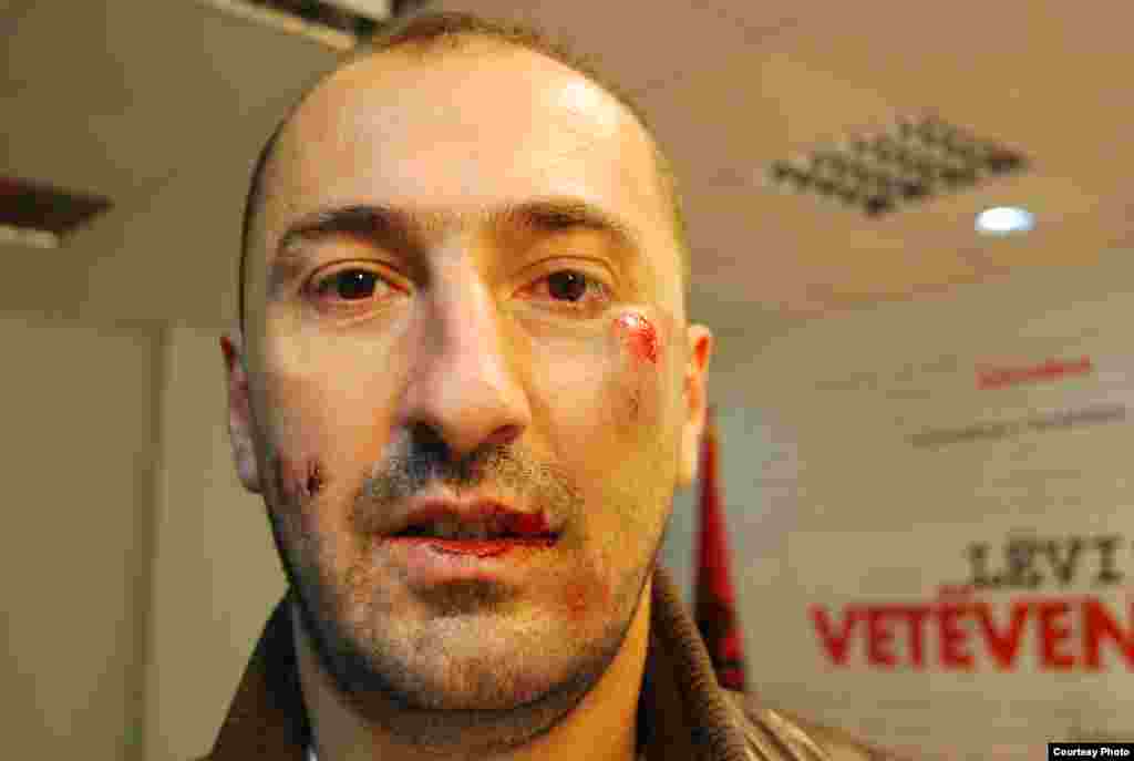 Liburn Aliu, un deputat rănit în timpul ciocnirilor cu poliția.