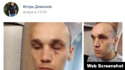 Игорь Никитенко обнародовал в соцсети фото с синяками на лице и виске после встречи с Михаилом Шереметом