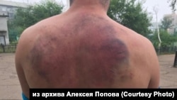 Травмы Алексея Попова после задержания росгвардейцами