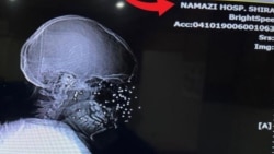 عکس رادیولوژی بیمارستان نمازی شیراز، از جمجمه معترضی که به صورتش شلیک شده است