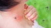 Pentru persoanele alergice, înțepăturile de insecte pot fi periculoase.