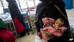 یکی از اطفال مبتلا به سوء تغذیه در جنوب افغانستان 