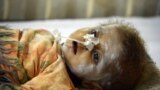 Súlyosan alultáplált pakisztáni gyerek kórházi kezelése Karacsitól mintegy háromszáz kilométerre 2014. március 11-én
