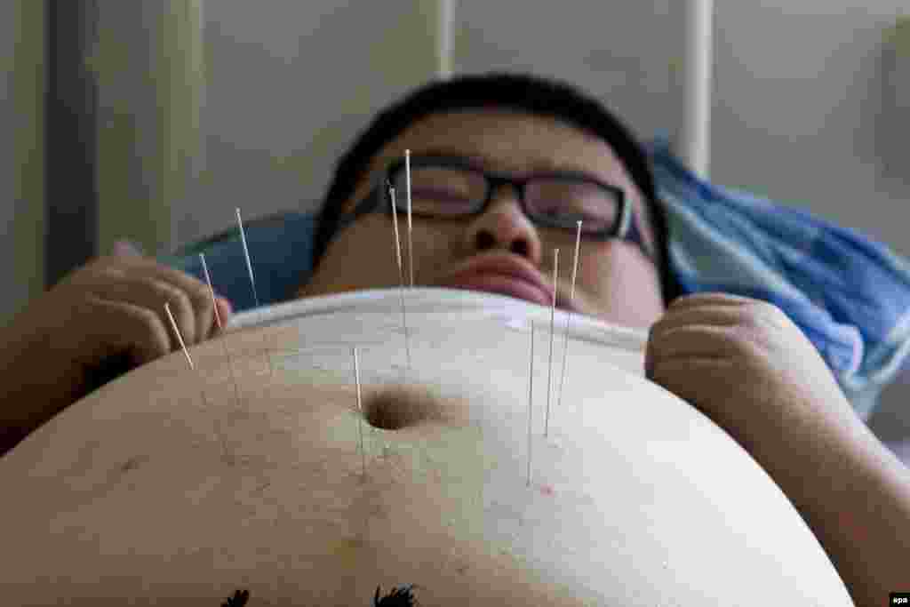 China -- Guang Yue aged 16 and weighing 138 kg receives acupuncture treatment at the Aimin Fat Reduction Hospital in Tianjin, China's largest facility of its kind, 10Jul2007