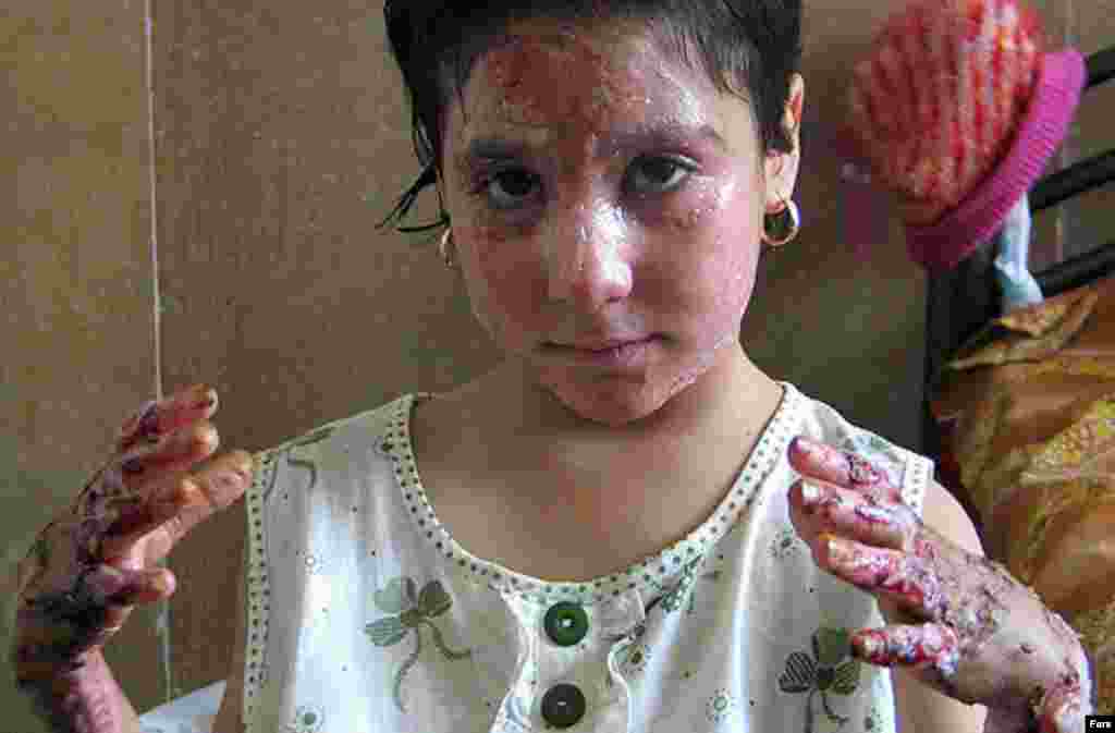 دختر دانش آموزی که در حادثه آتش سوزی کلاس درس در روستای دروزن از ناحیه دست و صورت دچار سوختگی شده است.