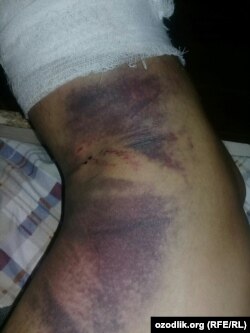 Shifokorlar futbolchi boldiridan shisha siniqlari olib tashladi