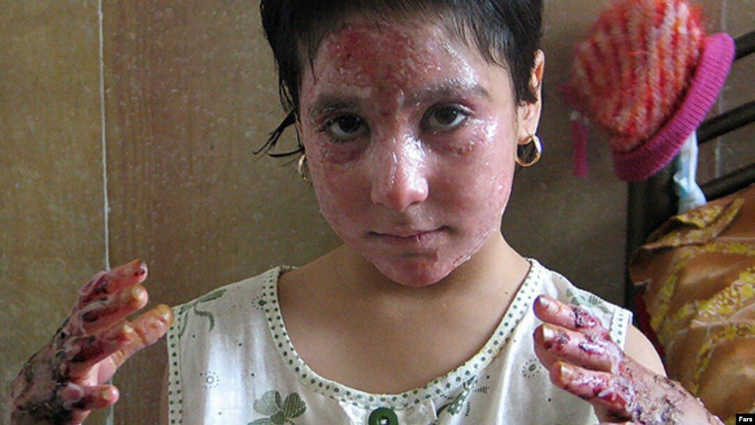 یک دختر دانش آموز در آتش سوزی کلاس درس در روستای درودزن از ناحیه دست ها و صورت دچار سوختگی شده است.