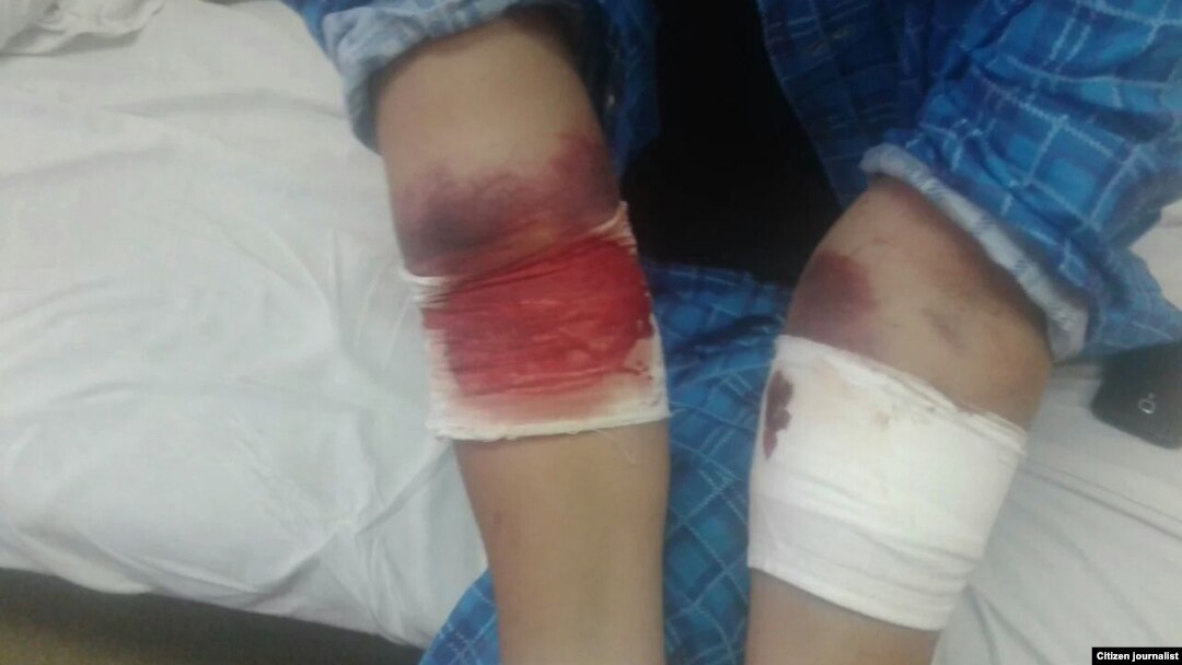 Заҳарланган 58 ўзбекистонликдан бирининг ички қон кетиш оқибатида кўкариб кетган билаклари.