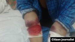 Один из отравившихся зоокумарином узбекистанцев истекает кровью. 