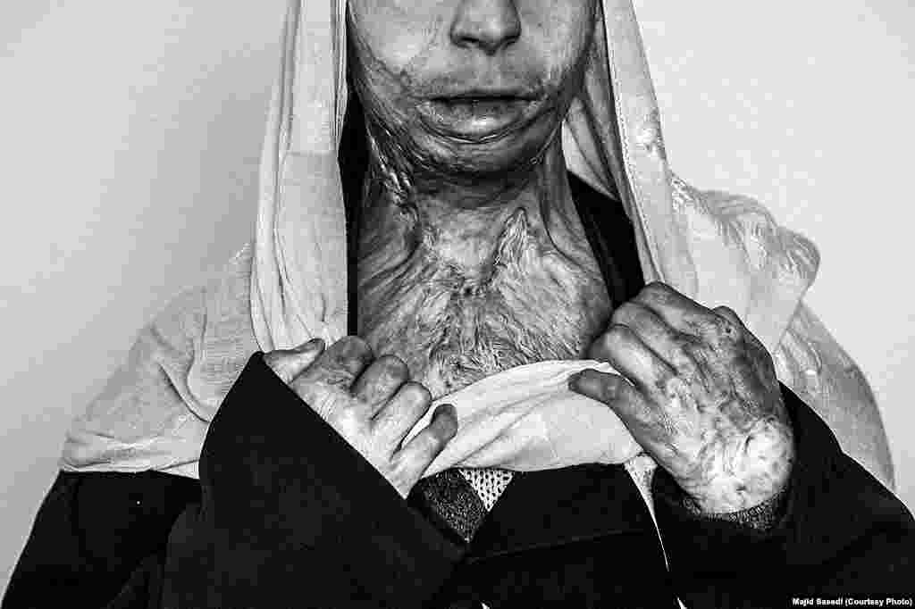 Majid Saeedi of Iran won second prize in the Contemporary Issues Stories category with his series "Life In War." This picture shows Zahra, 20, from the Afghan city of Herat, who set fire to herself four years ago. Conservative Islamic laws and tribal traditions frequently dictate what women are allowed to do. Forced marriages, domestic violence, poverty, and lack of access to education are among the main reasons self-immolations take place.