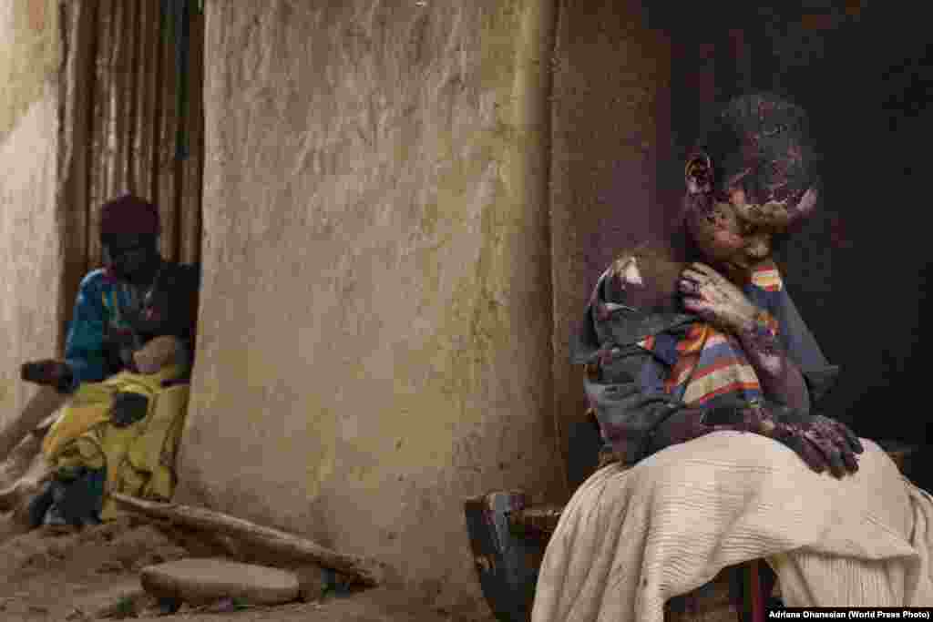 Second Prize Singles in the Contemporary Issues category was won by American freelance photographer Adriane Ohanesian. The image shows Adam Abdel, 7, who was severely burned after a bomb was dropped by a Sudanese government Antonov plane next to his family home in Burgu, Central Darfur, Sudan. (February 27, 2015) 