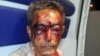 Azeri Rights Activist Severely Beaten