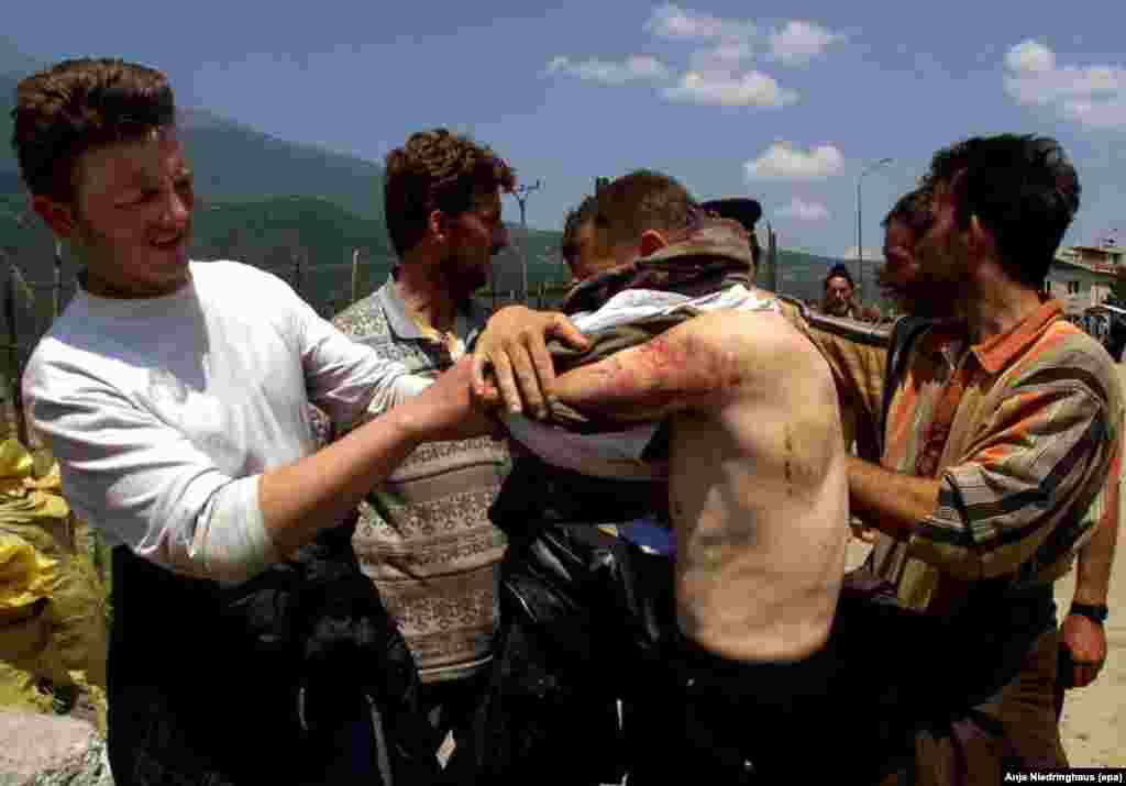 A Kosovo Albanian refugee shows his wounds after crossing the border from Yugoslavia into Albania on May 29, 1999.