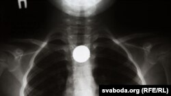An X-ray, from Belarus's Scientific and Practical Center of Pediatric Surgery, showing a swallowed coin.
