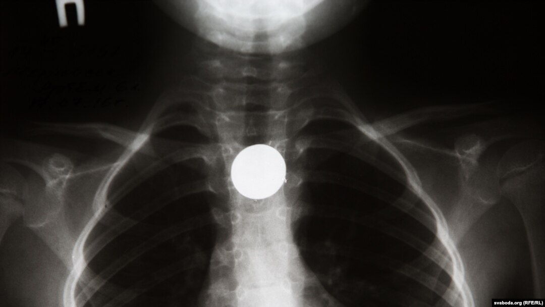 An X-ray, from Belarus's Scientific and Practical Center of Pediatric Surgery, showing a swallowed coin.