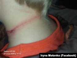 Сліди на шиї хлопчика