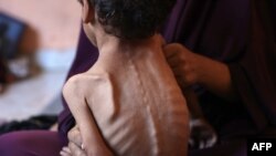 Palestinka Naeema drži svog neuhranjenog dvogodišnjeg sina u izbjegličkom kampu Al-Shati, zapadno od Gaze, 23. jula 2025.