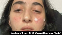 Кето Хомерики после разгона митинга, декабрь 2024 г.