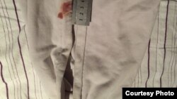 Mehman Hüseynov. İşgəncə izləri. 11yan2017