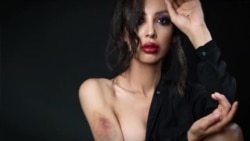 کبودی بدن مدل قزاقستانی
