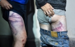 Следы избиений, которым подвергались задержанные на акциях протеста в Минске в центре изоляции правонарушителей на улице Окрестина