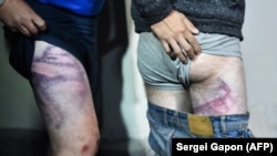 People detained during the August 2020 protests show bruises that they say were the result of beatings they experienced at Minsk's Akrestsina remand prison.