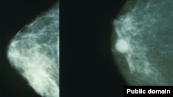 Кўкрак маммограммаси: соғлом кўкрак (чапда) ва саратонга салинган кўкрак.
