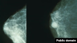 طرف راست پستان مصاب به سرطان طرف و طرف چپ پستان صحتمند قرار داردند.
