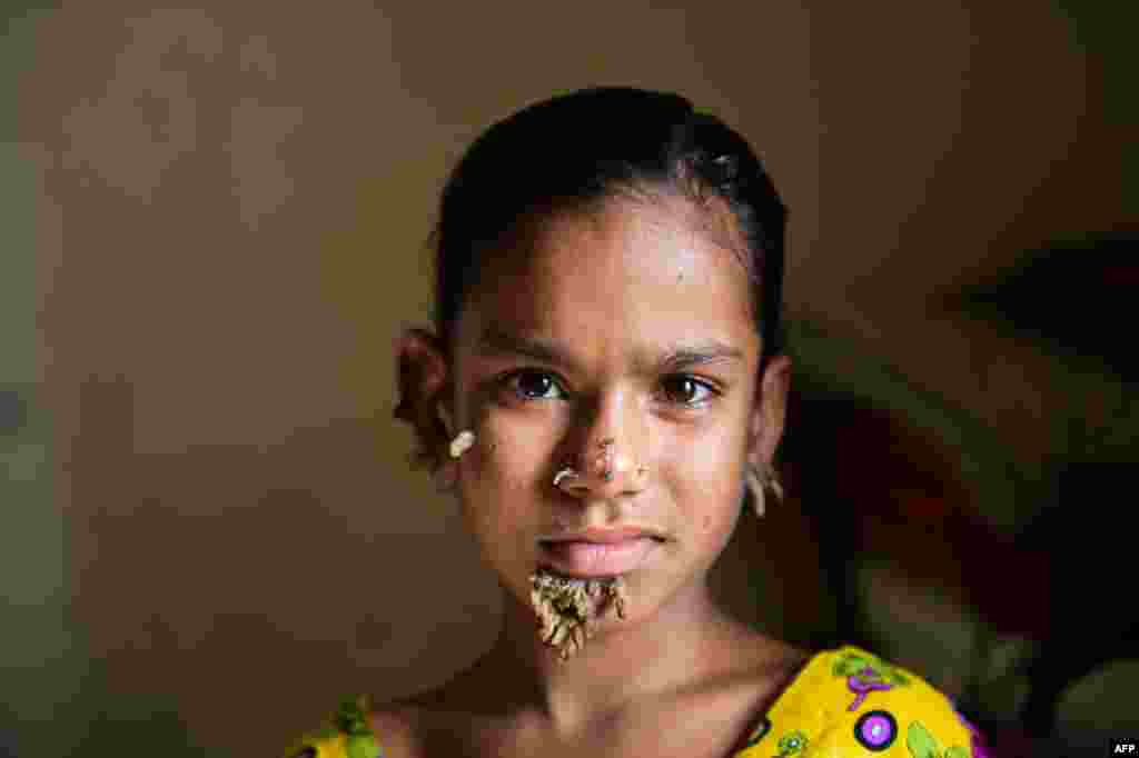 Bangladeshi patient Sahana Khatun, 10, poses for a photograph at the Dhaka Medical College and Hospital. Khatun, who has barklike warts growing on her face, could be the first female ever afflicted by the so-called "tree-man syndrome." (AFP)