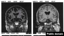 Два томографических снимка мозга. Справа - нормальный мозг, слева - пораженный болезнью Альцгеймера