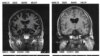 Komjuterizovana tomografija glave pokazuje razliku u nalazu kod pacijenta s Alzheimerovom bolesti i kod zdravog pojedinca, arhivska fotografija