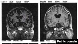 Komjuterizovana tomografija glave pokazuje razliku u nalazu kod pacijenta s Alzheimerovom bolesti i kod zdravog pojedinca, arhivska fotografija