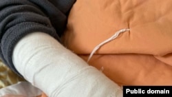 Կոտրվածք ստացած Երևանի բնակիչ Անահիտ Նաղդալյանը