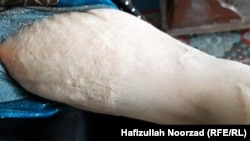 یکی از زنانی که در ولایت فراه مورد خشونت قرار گرفته است