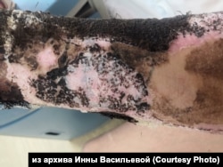 Рука несовершеннолетнего Максима Кокорина после пожара в полицейской машине