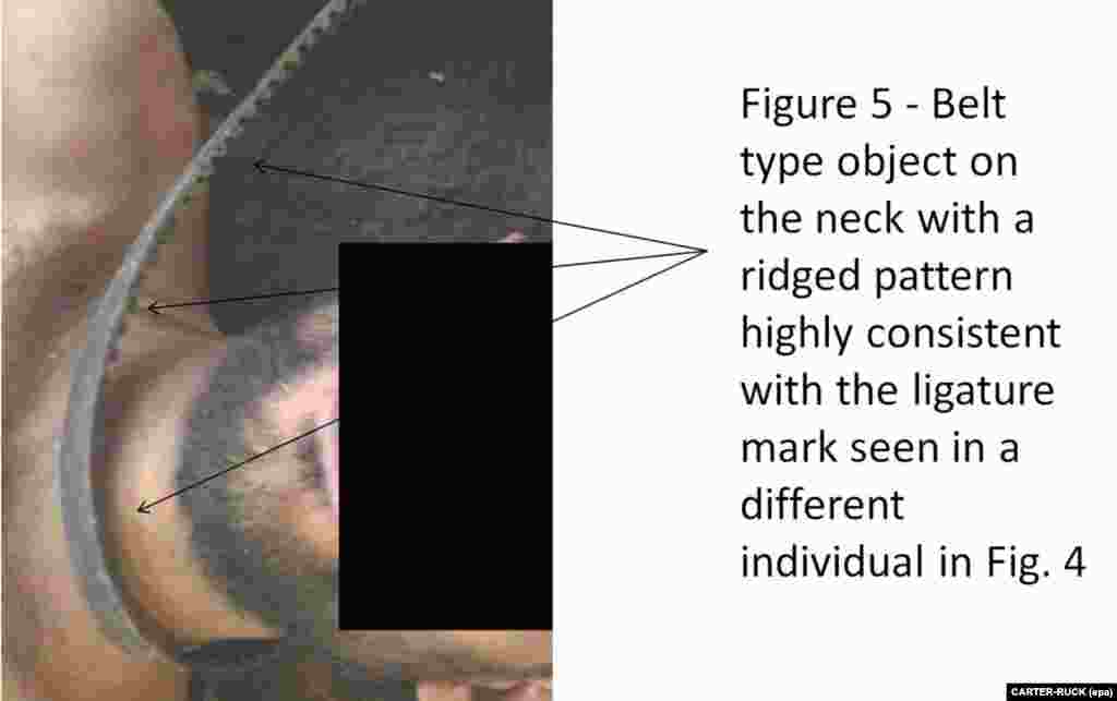 An undated photograph showing a ridged belt around a man&#39;s neck. 