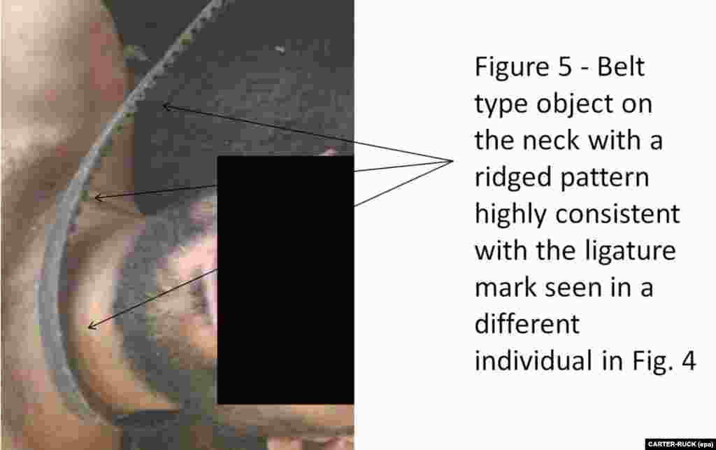 An undated photograph showing a ridged belt around a man's neck.