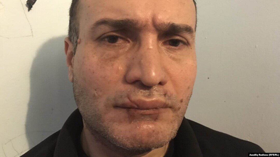 Nijat İbrahim bir neçə il öncə ağzını tikib, aclıq etməklə polislərə qarşı etiraz aksiyası keçirmişdi.