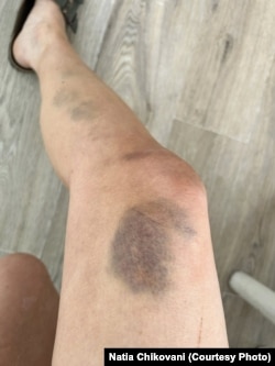 ნათია ჩიქოვანის დაზიანებული ფეხი