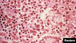 FOTO DE ARHIVĂ: O examinare la microscop a țesutului hepatic prelevat de la un pacient cu sindrom pulmonar cauzat de hantavirus (HPS)