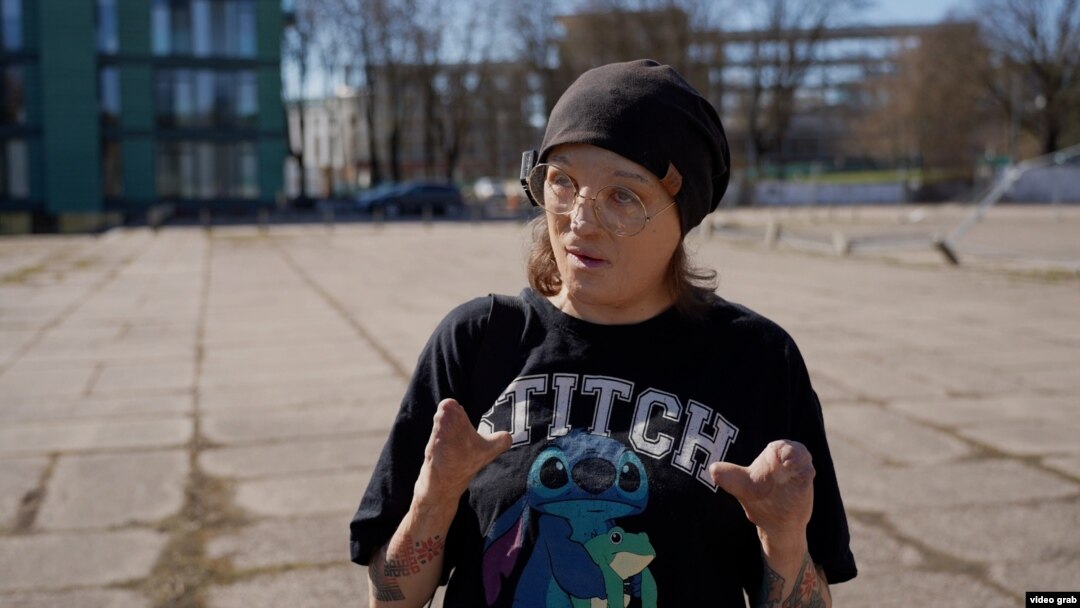 Belarusian comedian Sasha Hushcha suffered severe burns. She left Belarus fearing persecution for her activism.