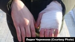 Руки избитого при задержании ГИБДД Юрия Ямашкина из Куйтуна